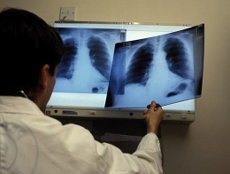 Флюорография как метод профилактики туберкулеза